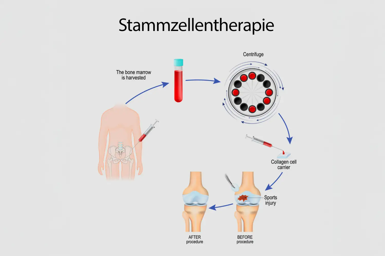 darstellung des verfahrens einer stammzellentherapie