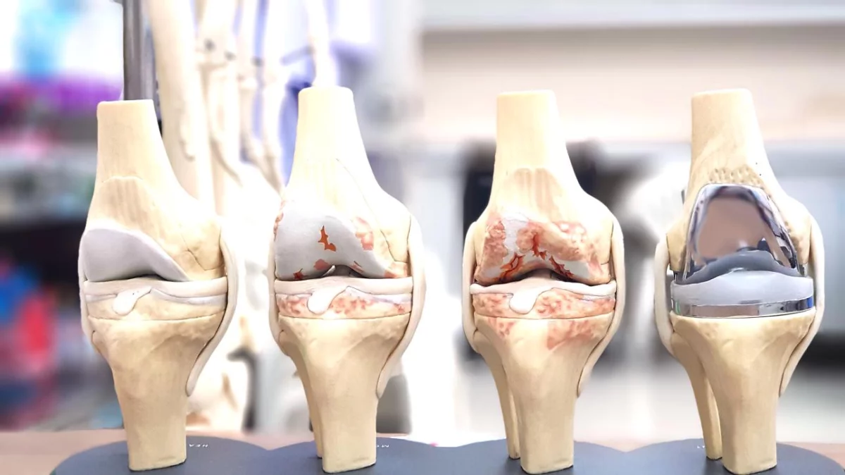 arthrose im kniegelenk